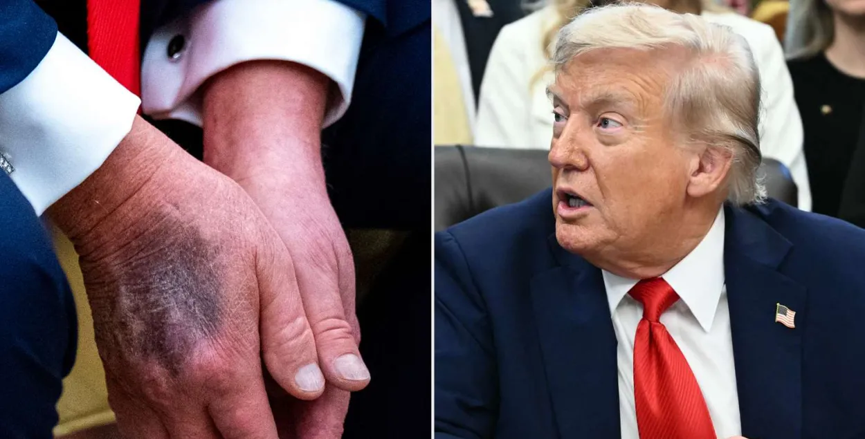 Синяки на руках Трампа беспокоят врачей
